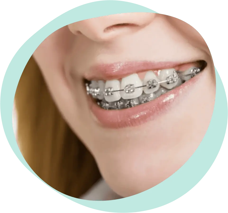 Šta Je Fiksna Proteza