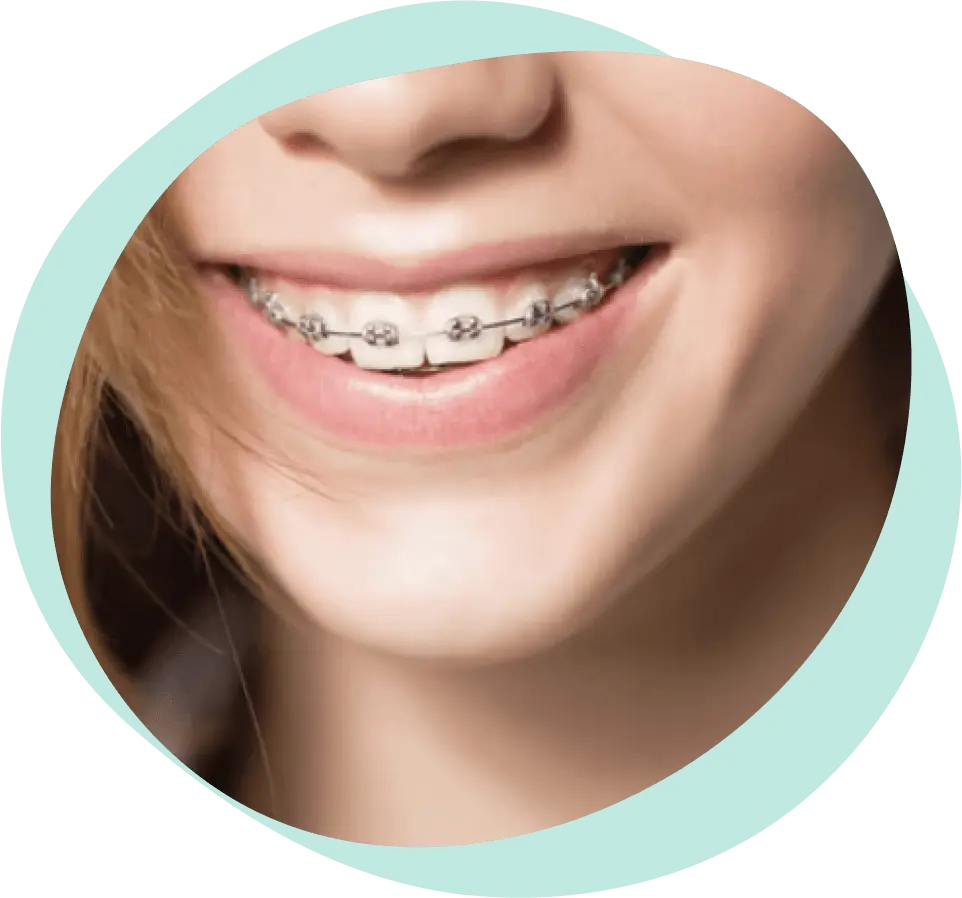 Vrste Fiksnih Proteza